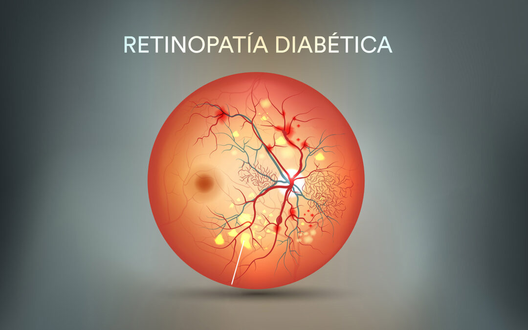 RESVERATROL EN LA RETINOPATÍA DIABÉTICA